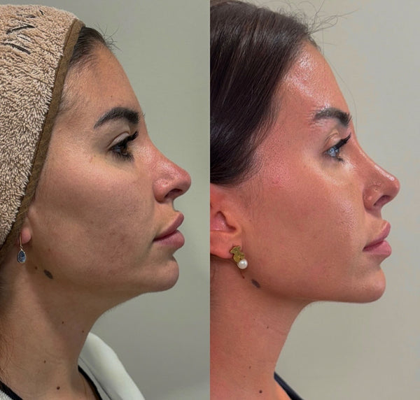 Mentón y línea mandibular